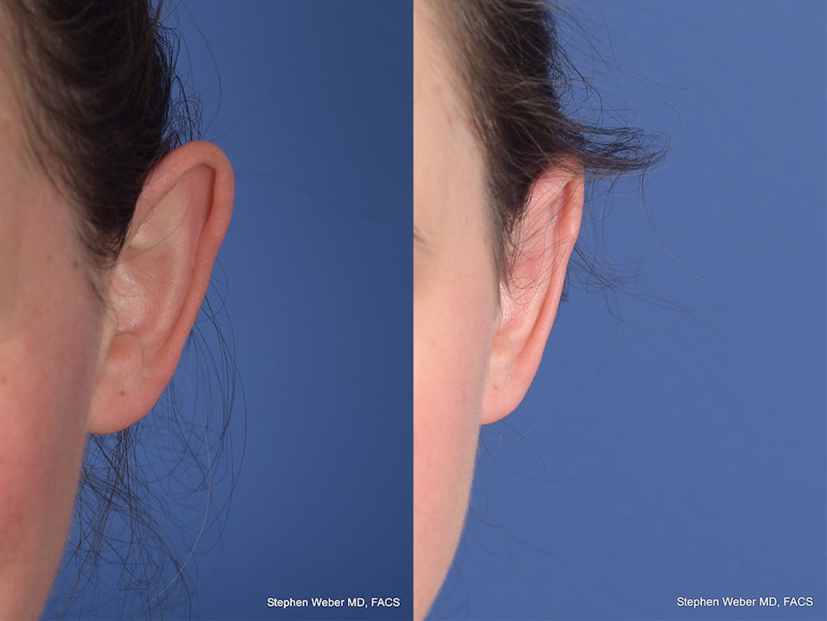 Otoplasty Before & After Gallery - Patient 211565 - Image 1