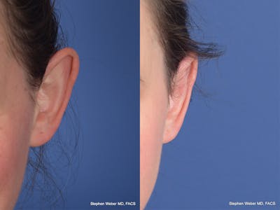 Otoplasty Before & After Gallery - Patient 211565 - Image 1
