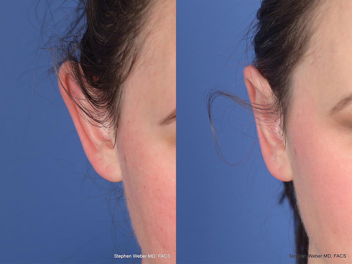 Otoplasty Before & After Gallery - Patient 211565 - Image 2