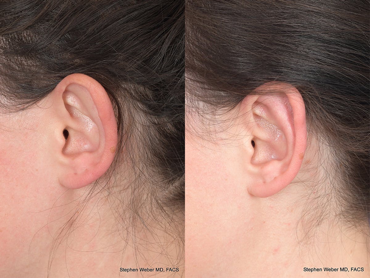 Otoplasty Before & After Gallery - Patient 211565 - Image 3