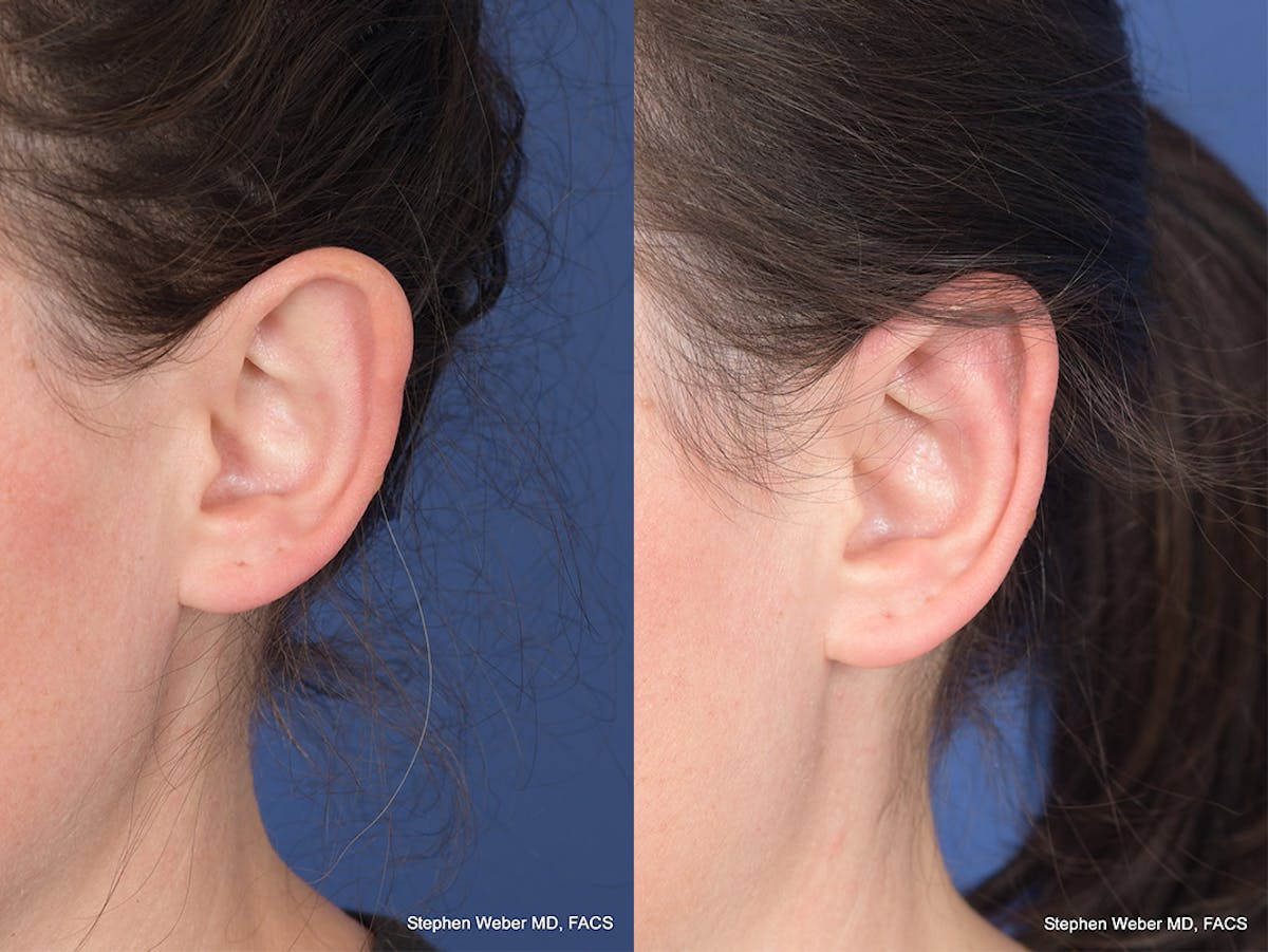 Otoplasty Before & After Gallery - Patient 211565 - Image 4