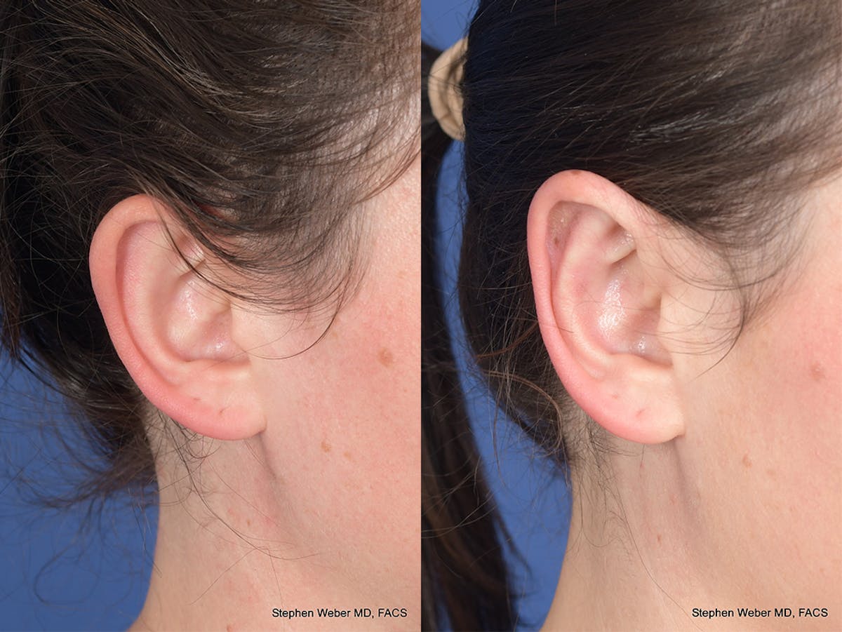 Otoplasty Before & After Gallery - Patient 211565 - Image 5