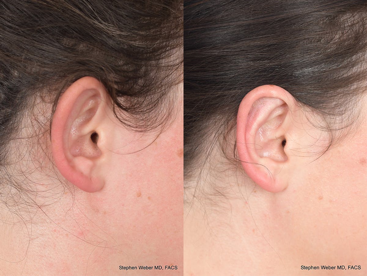Otoplasty Before & After Gallery - Patient 211565 - Image 6