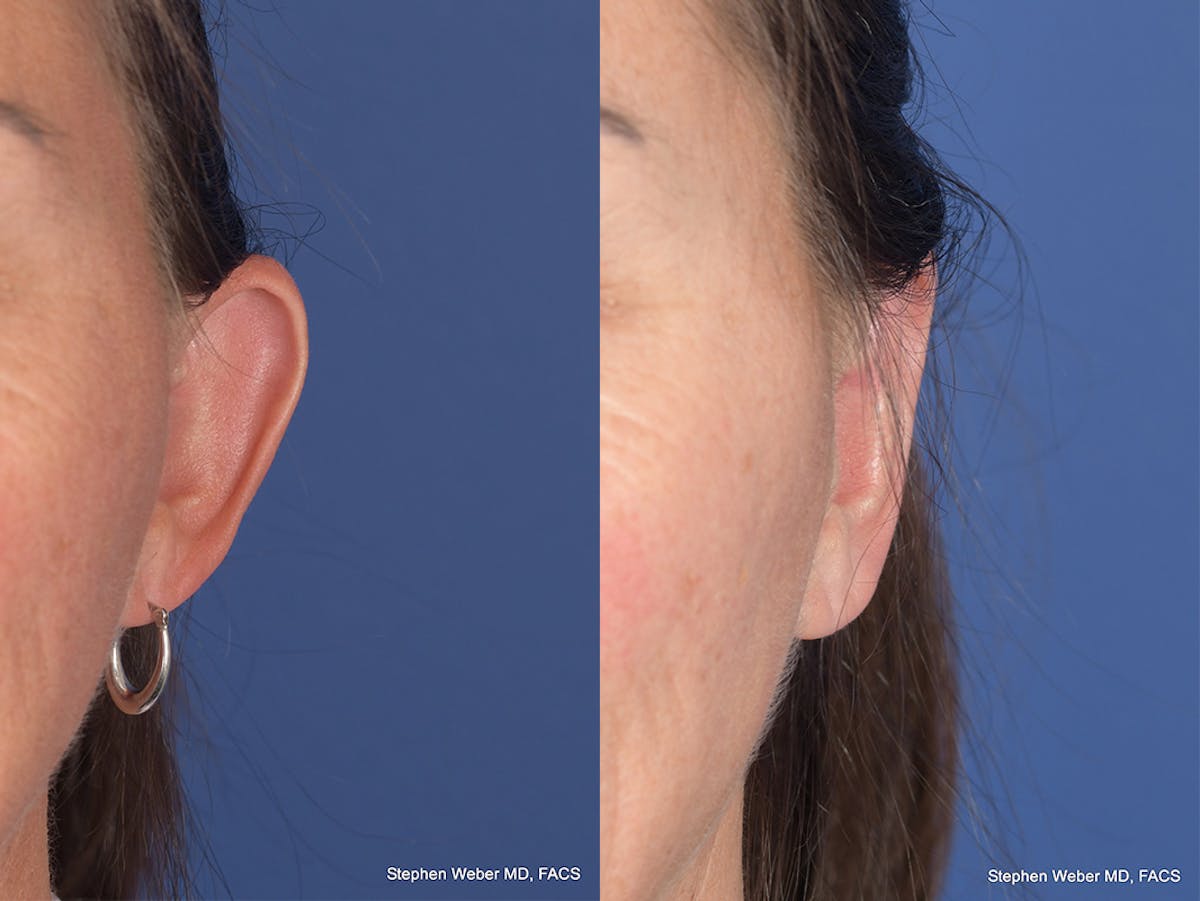 Otoplasty Before & After Gallery - Patient 192479 - Image 1