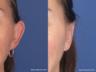 Otoplasty Before & After Gallery - Patient 192479 - Image 1