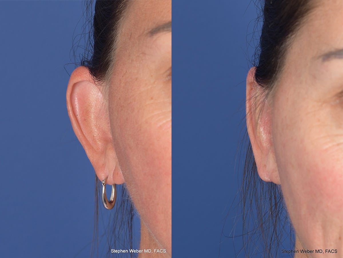 Otoplasty Before & After Gallery - Patient 192479 - Image 2