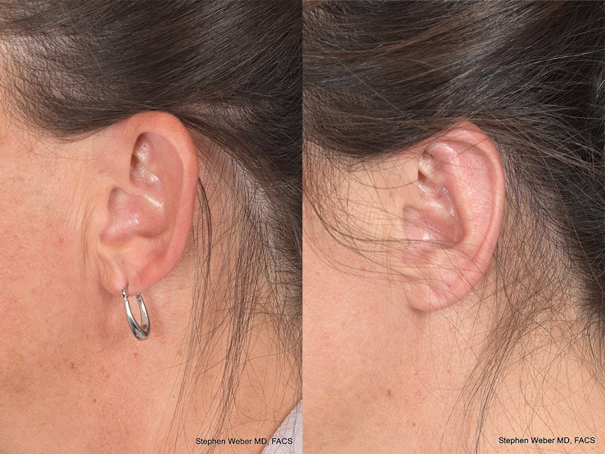 Otoplasty Before & After Gallery - Patient 192479 - Image 3