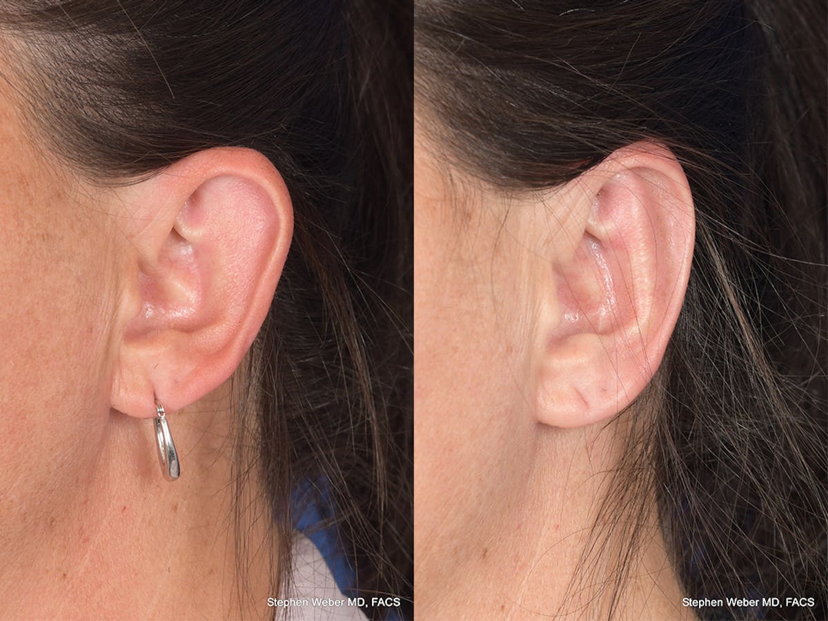 Otoplasty Before & After Gallery - Patient 192479 - Image 4