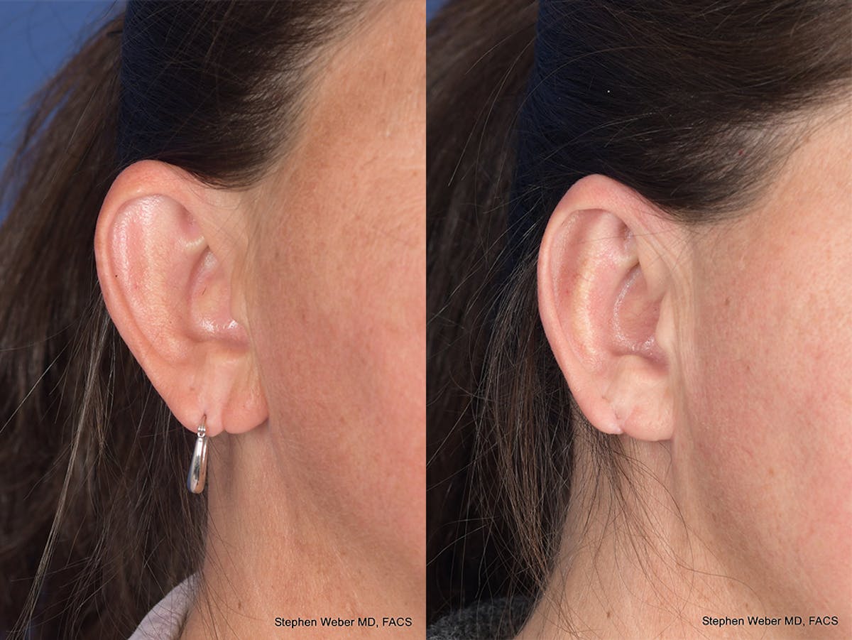 Otoplasty Before & After Gallery - Patient 192479 - Image 5