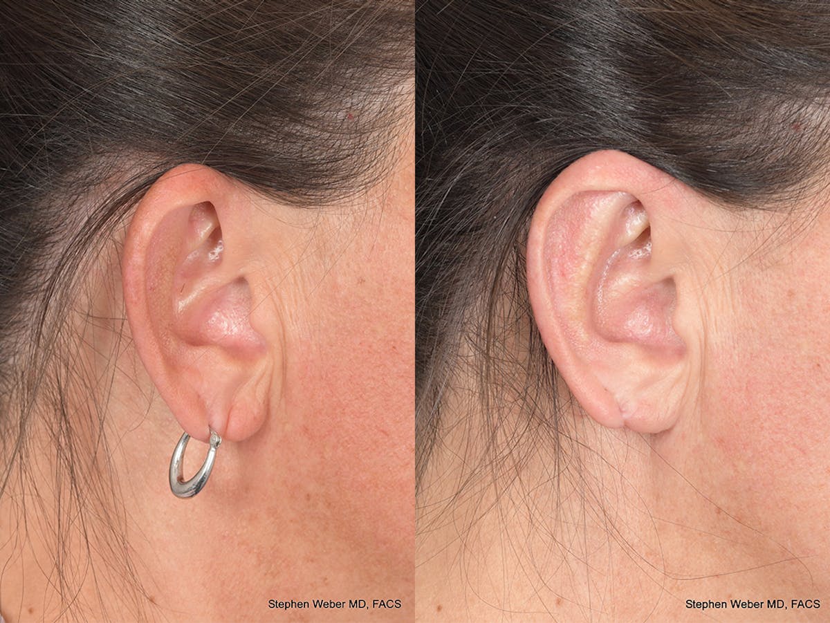 Otoplasty Before & After Gallery - Patient 192479 - Image 6