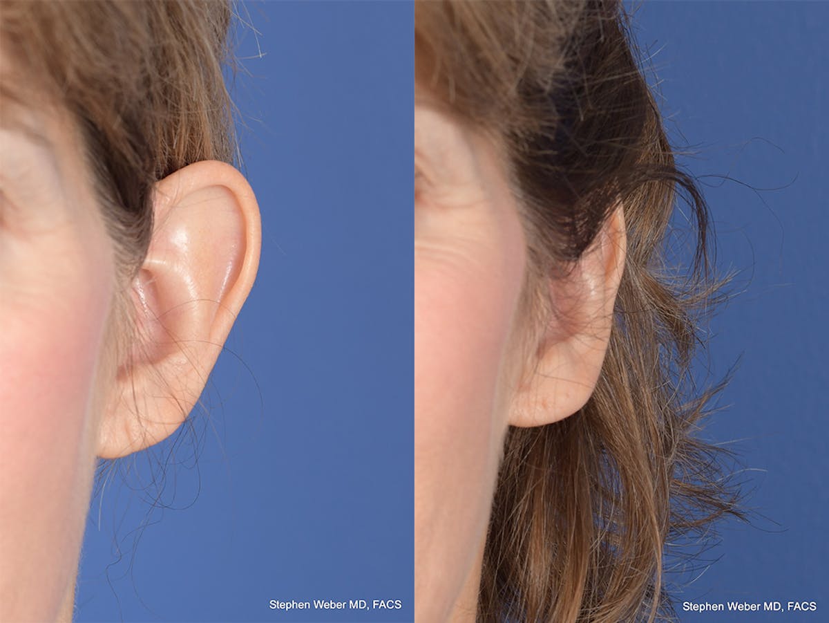 Otoplasty Before & After Gallery - Patient 265050 - Image 1