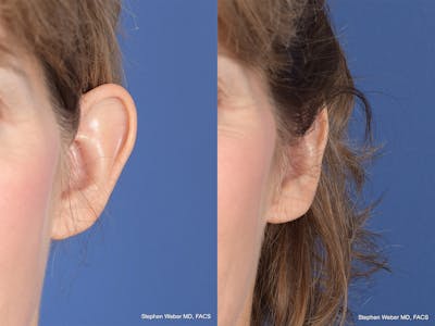 Otoplasty Before & After Gallery - Patient 265050 - Image 1
