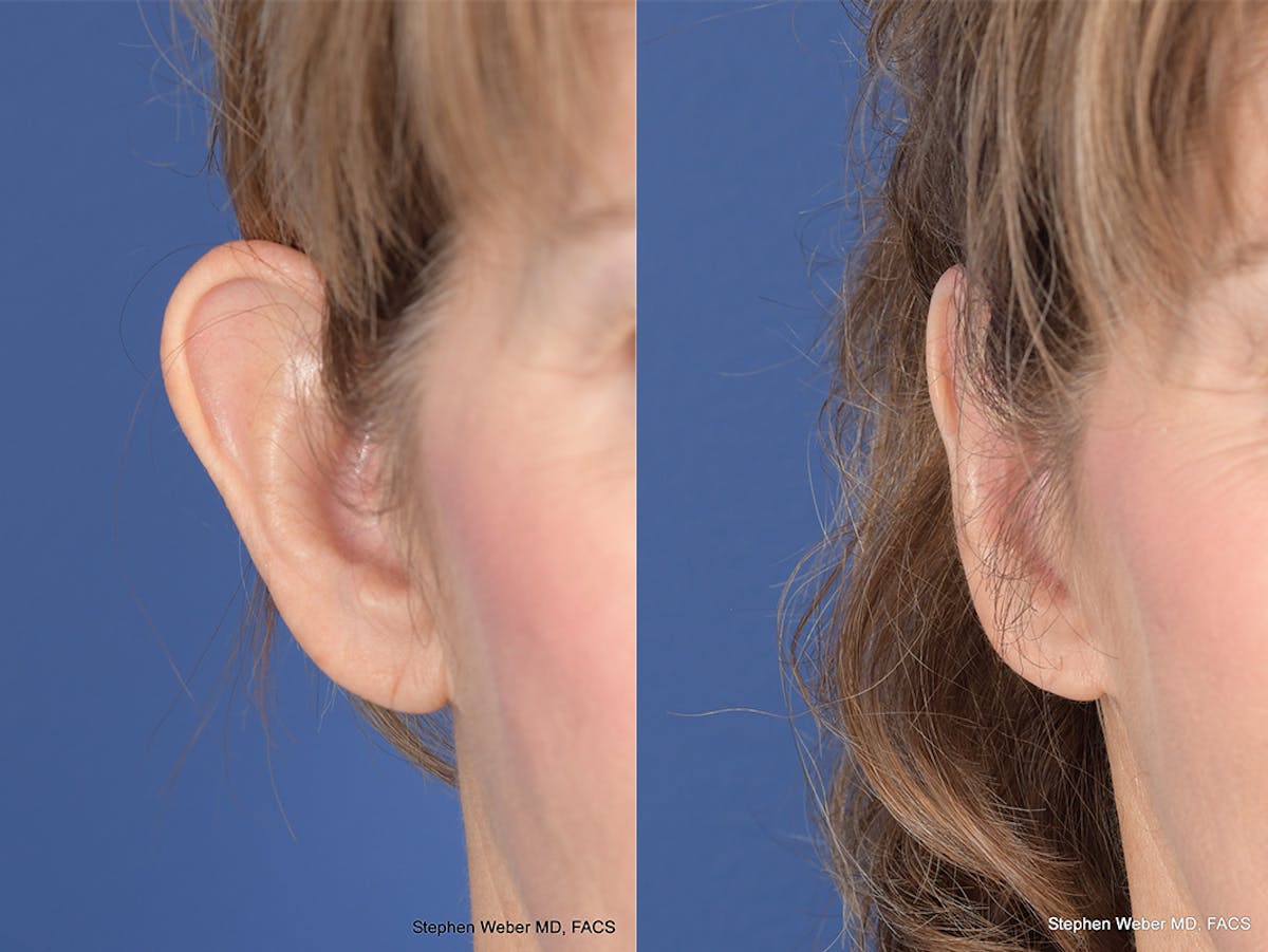 Otoplasty Before & After Gallery - Patient 265050 - Image 2