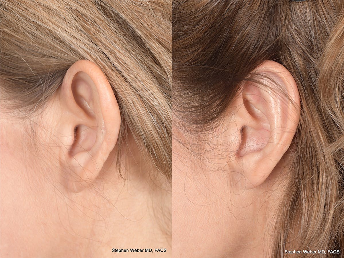 Otoplasty Before & After Gallery - Patient 265050 - Image 3