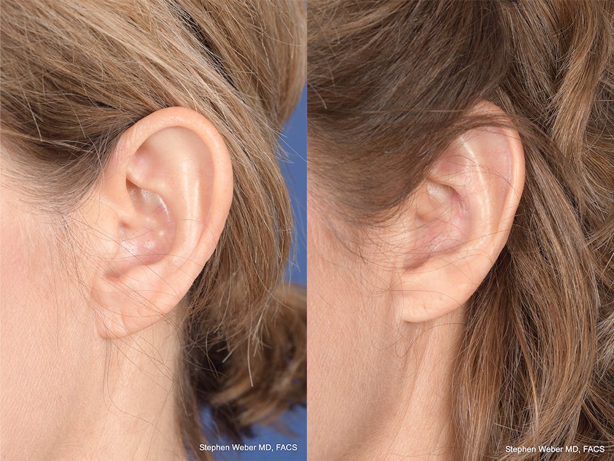 Otoplasty Before & After Gallery - Patient 265050 - Image 4