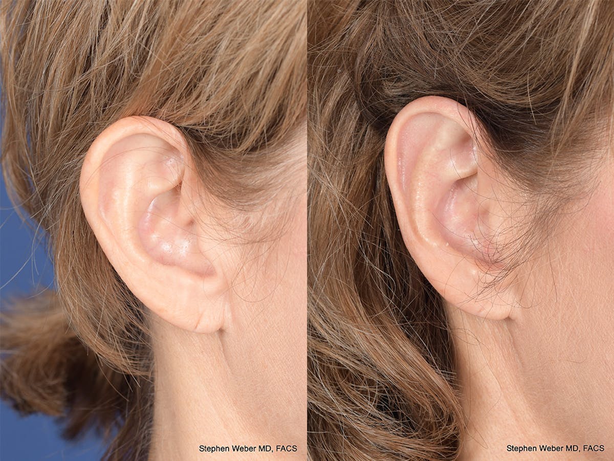 Otoplasty Before & After Gallery - Patient 265050 - Image 5