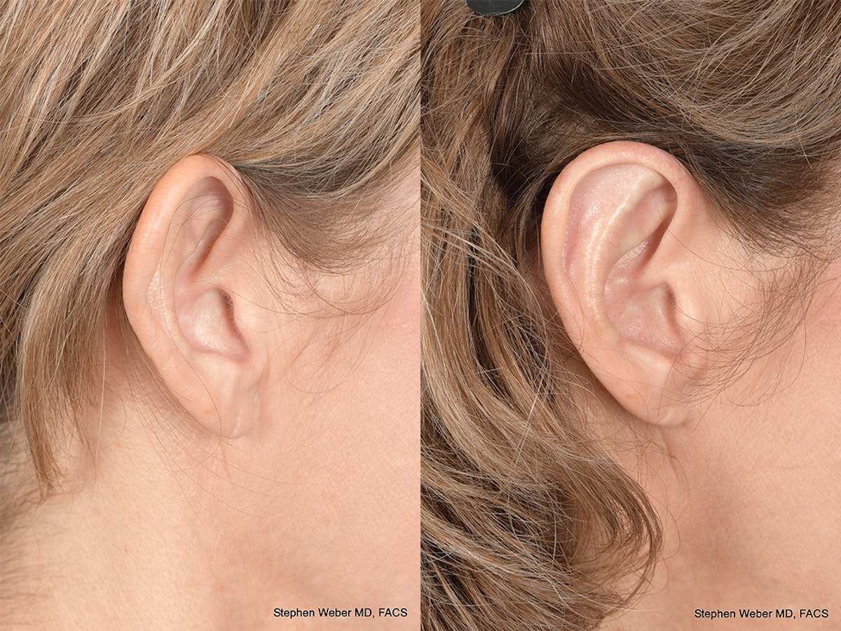 Otoplasty Before & After Gallery - Patient 265050 - Image 6