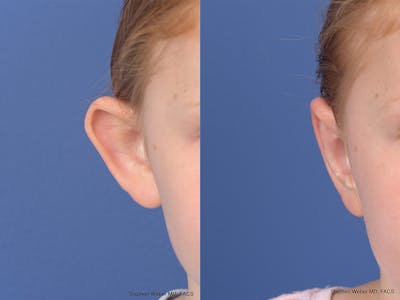 Otoplasty Before & After Gallery - Patient 415165 - Image 1