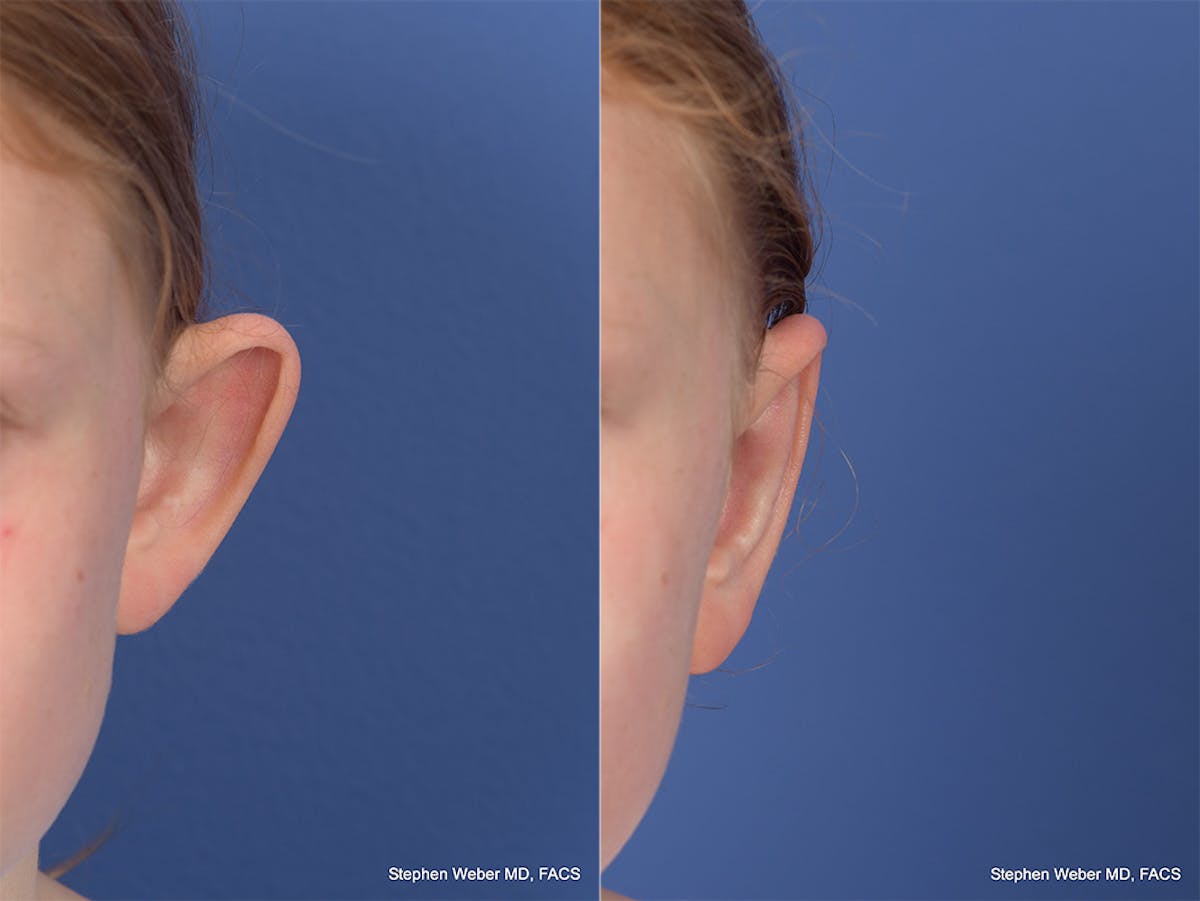 Otoplasty Before & After Gallery - Patient 415165 - Image 2