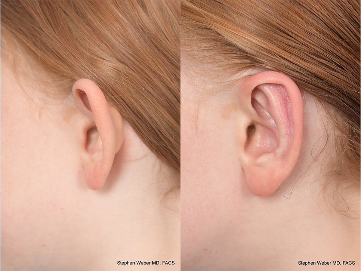 Otoplasty Before & After Gallery - Patient 415165 - Image 3