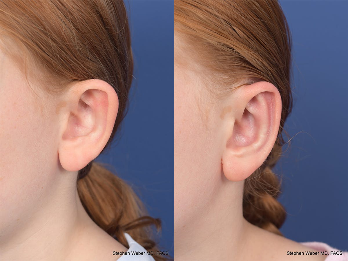 Otoplasty Before & After Gallery - Patient 415165 - Image 4