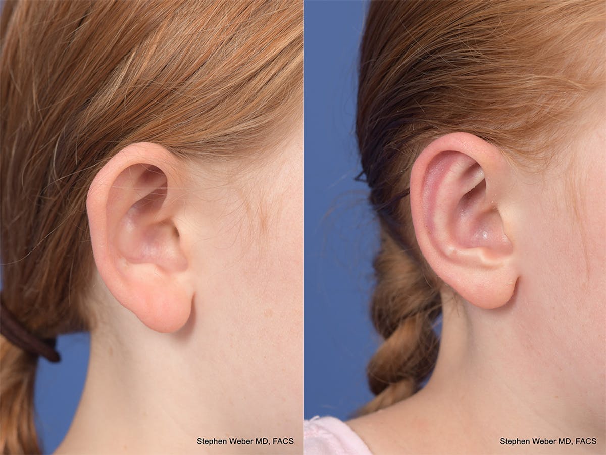 Otoplasty Before & After Gallery - Patient 415165 - Image 5