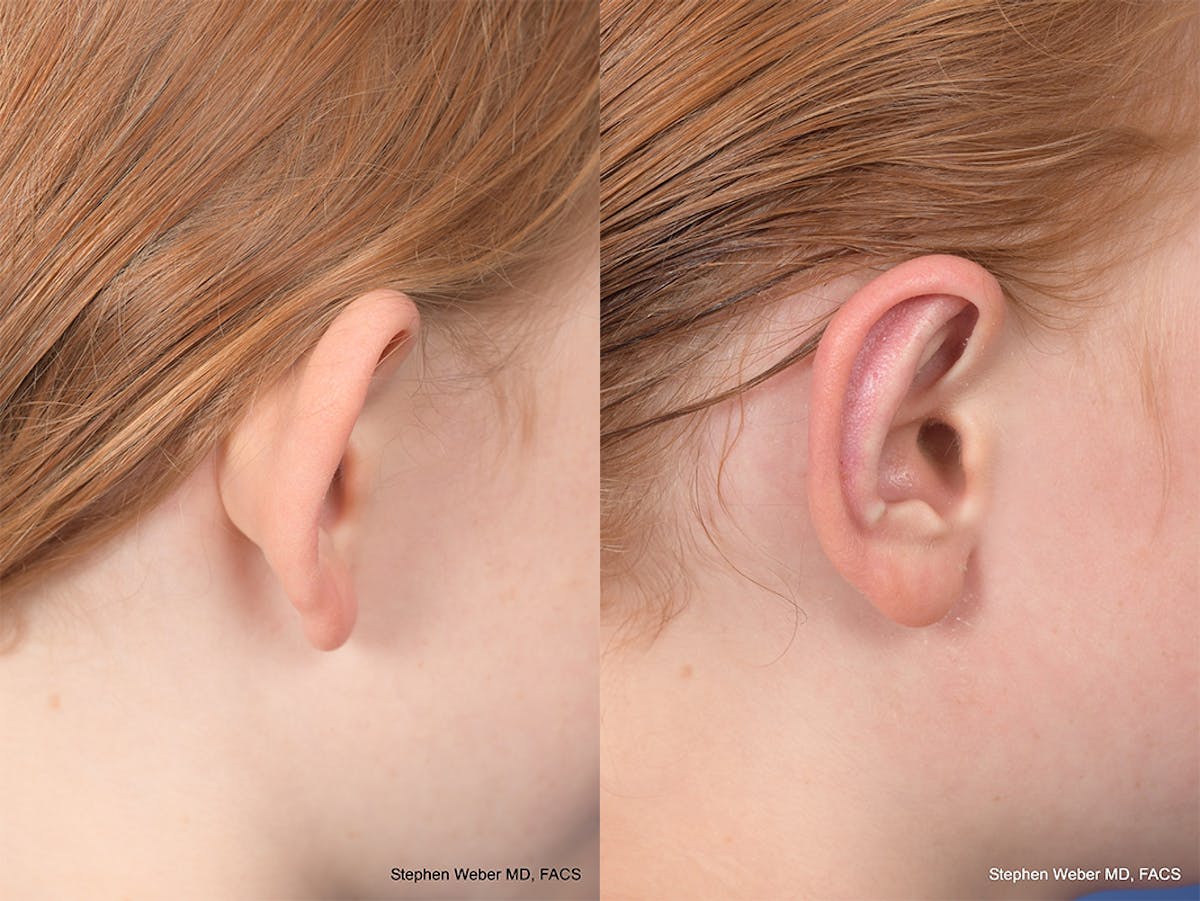Otoplasty Before & After Gallery - Patient 415165 - Image 6