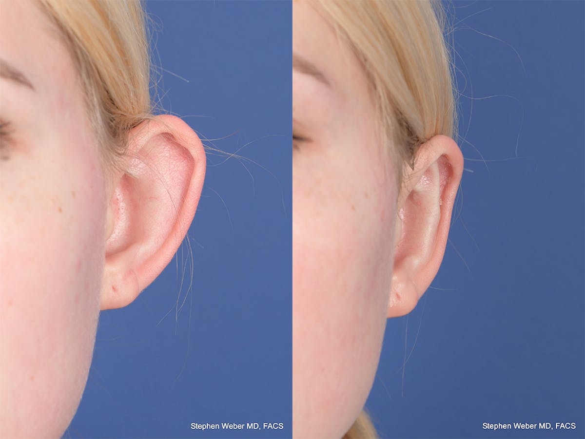 Otoplasty Before & After Gallery - Patient 842190 - Image 1