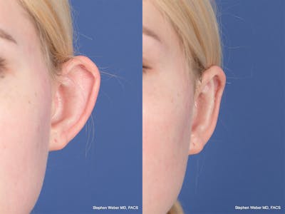 Otoplasty Before & After Gallery - Patient 842190 - Image 1