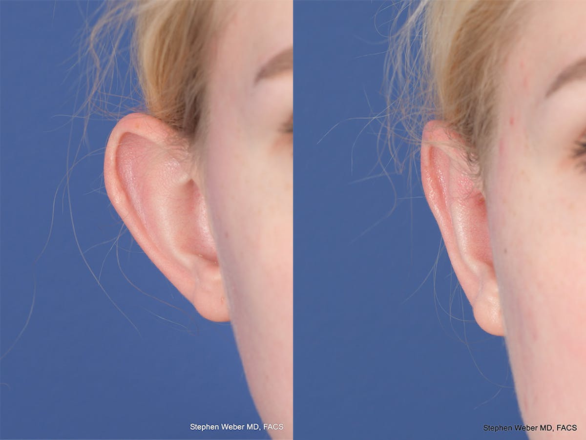 Otoplasty Before & After Gallery - Patient 842190 - Image 2