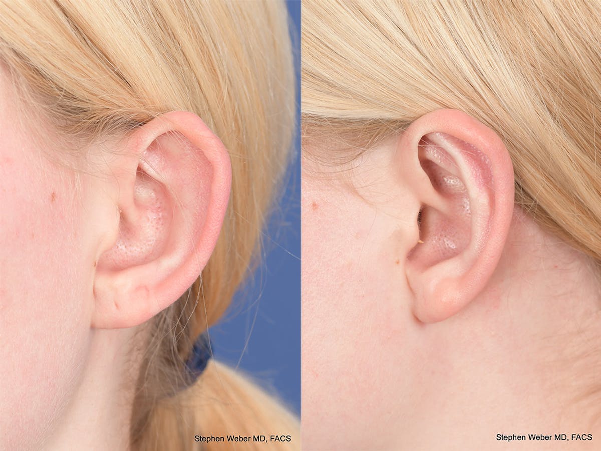 Otoplasty Before & After Gallery - Patient 842190 - Image 3