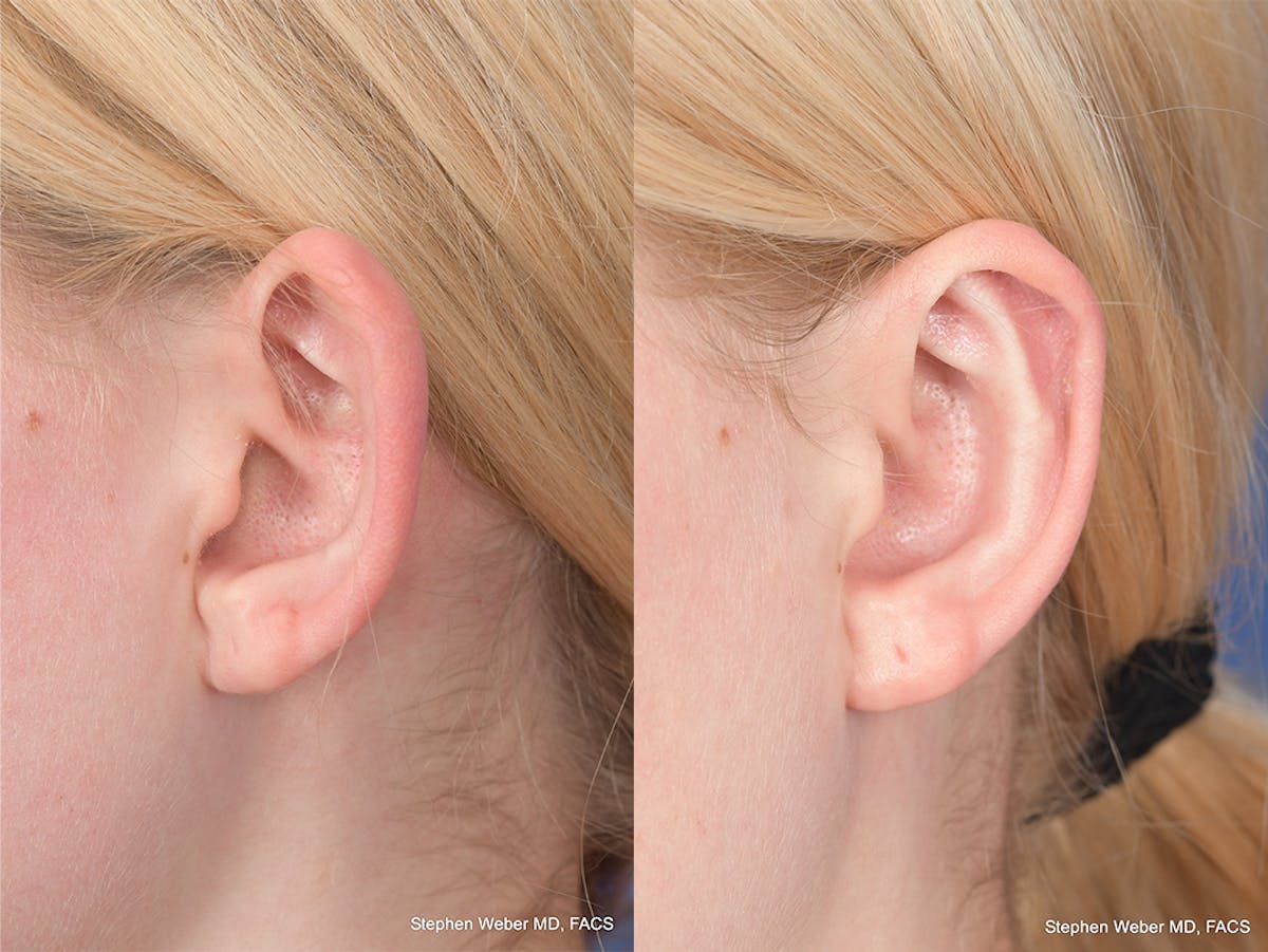 Otoplasty Before & After Gallery - Patient 842190 - Image 4