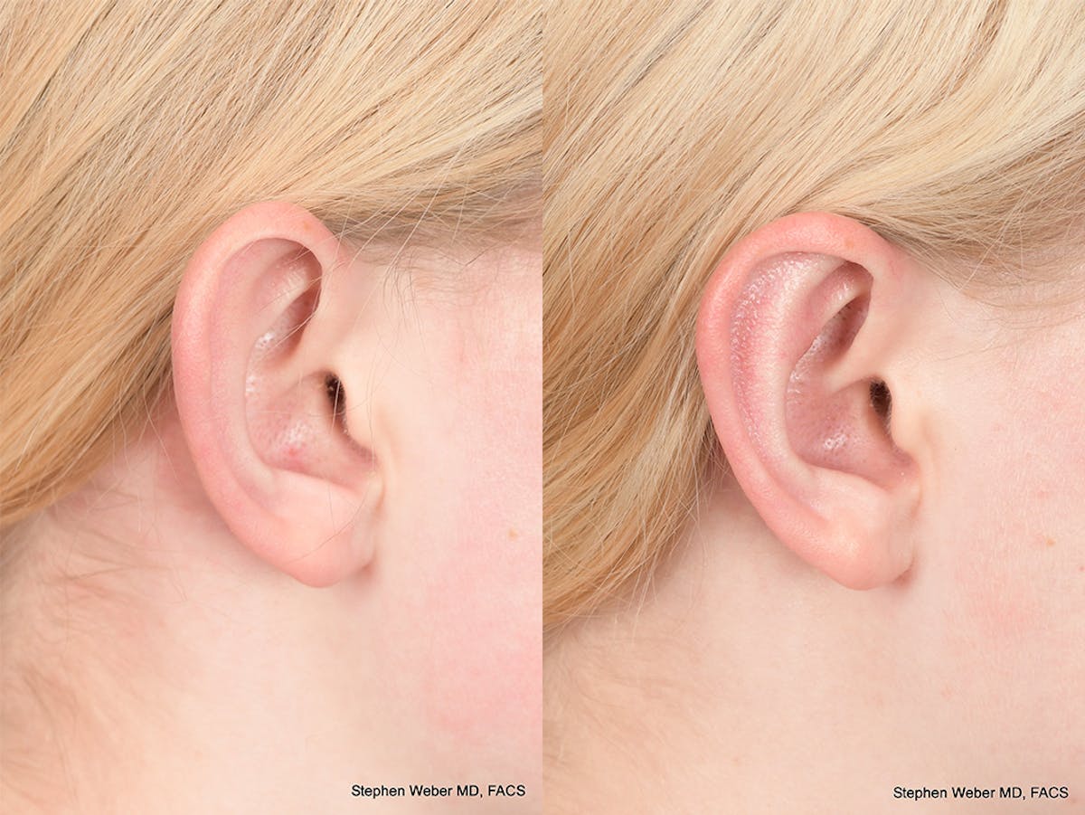 Otoplasty Before & After Gallery - Patient 842190 - Image 5