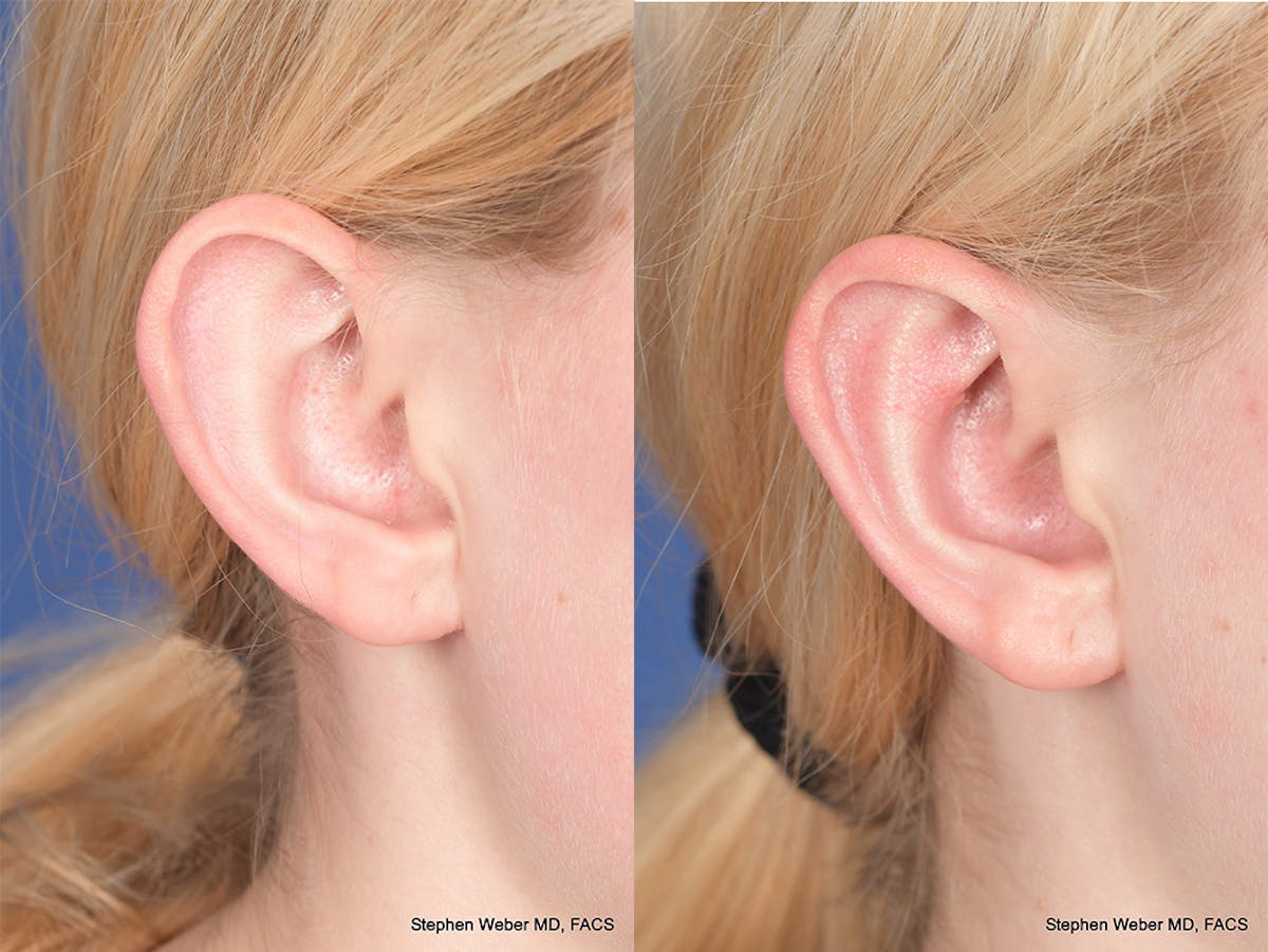 Otoplasty Before & After Gallery - Patient 842190 - Image 6
