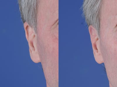 Otoplasty Before & After Gallery - Patient 257467 - Image 1