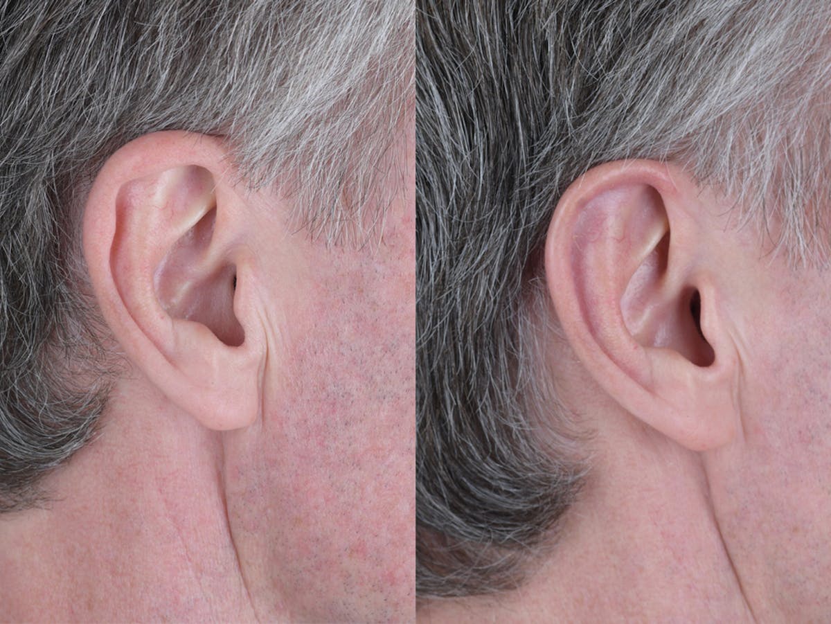 Otoplasty Before & After Gallery - Patient 257467 - Image 2