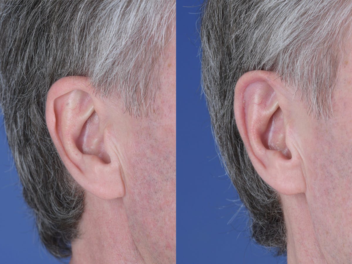 Otoplasty Before & After Gallery - Patient 257467 - Image 3