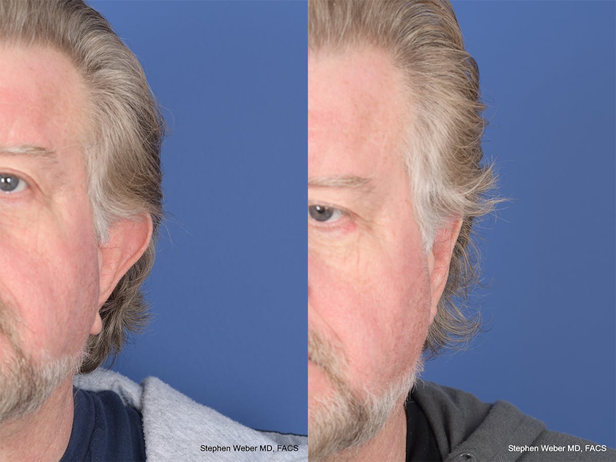 Otoplasty Before & After Gallery - Patient 347086 - Image 1