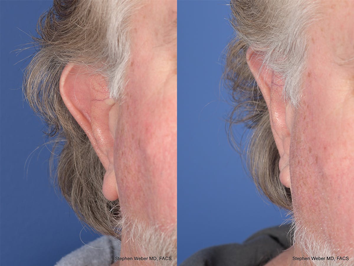 Otoplasty Before & After Gallery - Patient 347086 - Image 2