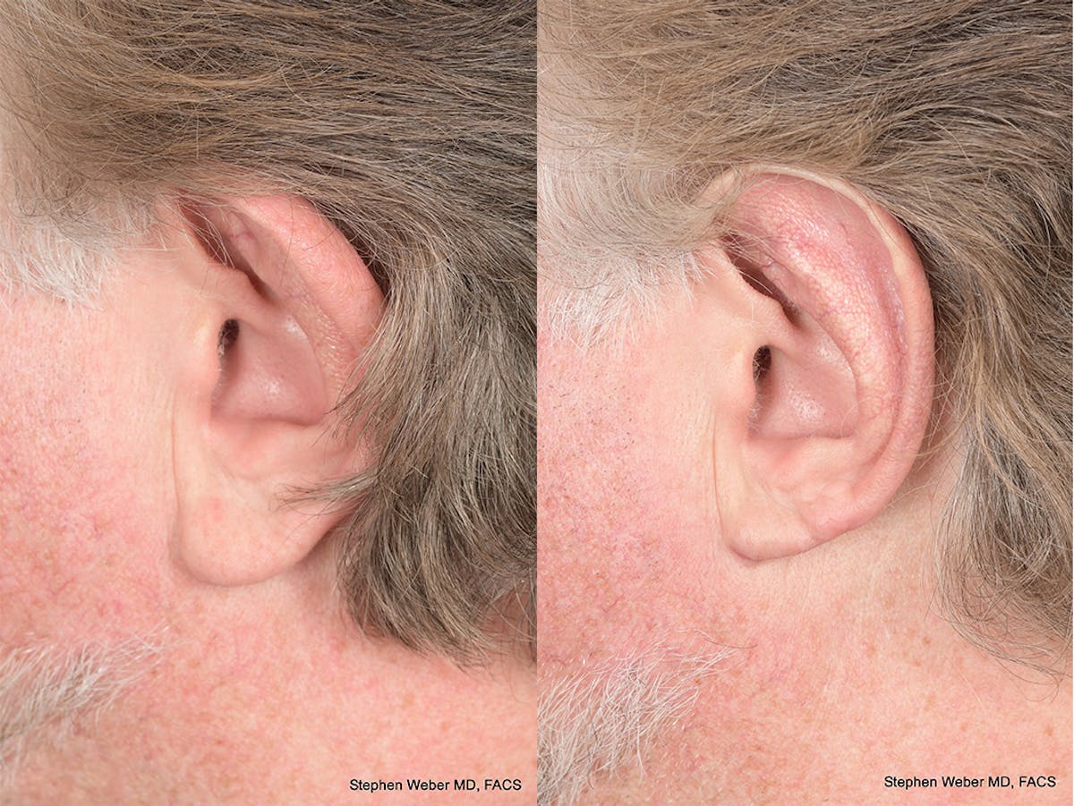 Otoplasty Before & After Gallery - Patient 347086 - Image 3
