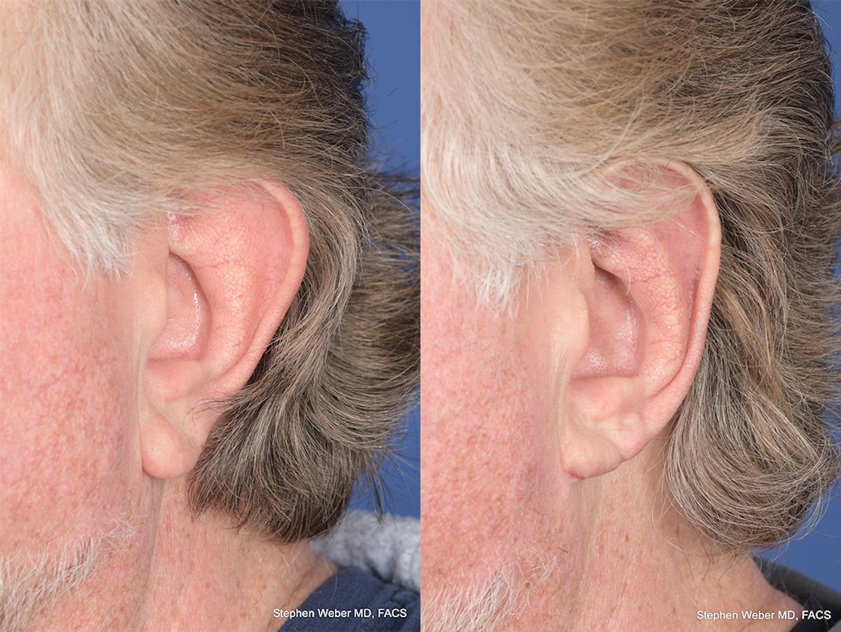 Otoplasty Before & After Gallery - Patient 347086 - Image 4