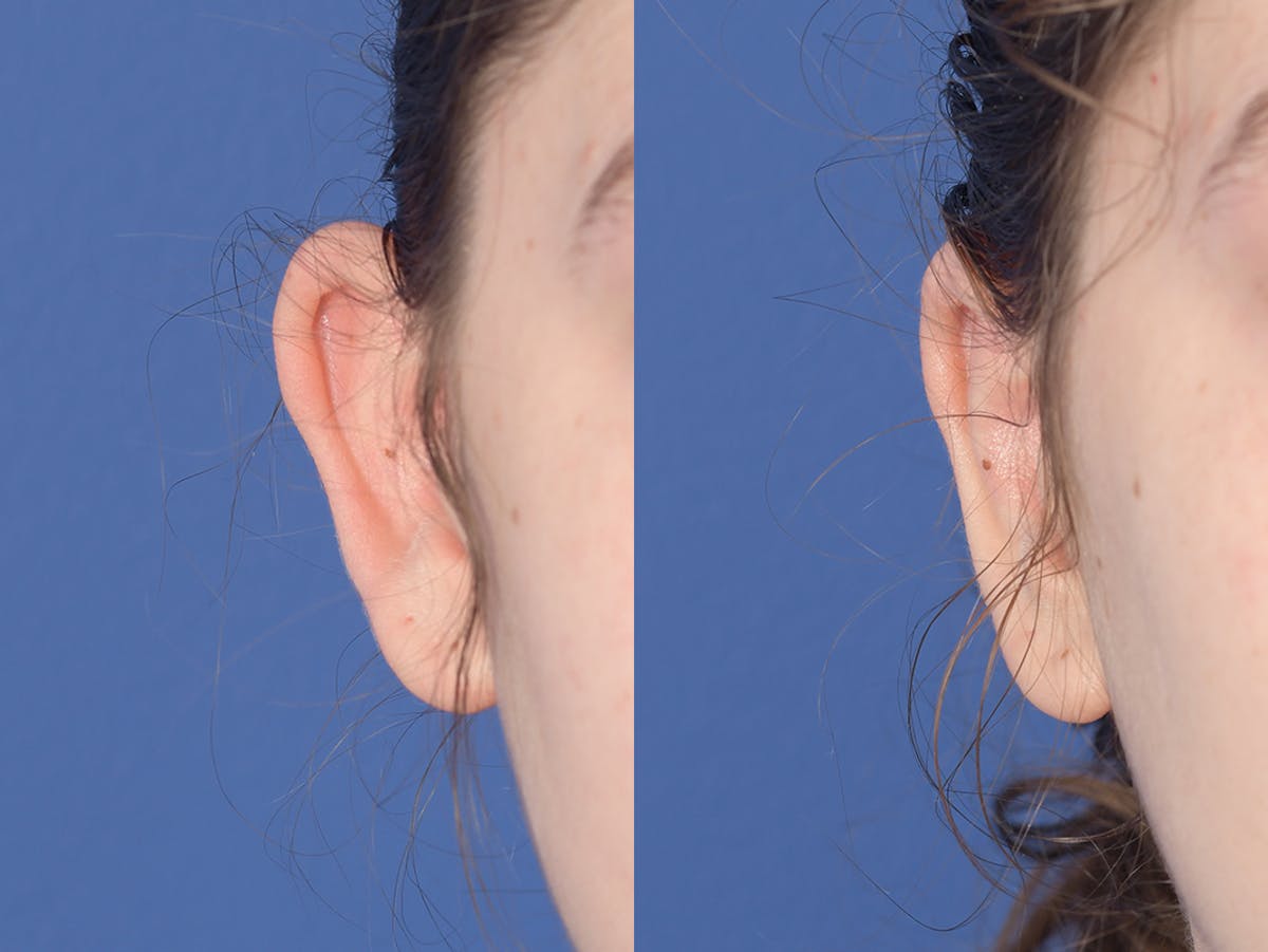 Otoplasty Before & After Gallery - Patient 330757 - Image 1