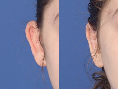 Otoplasty Before & After Gallery - Patient 330757 - Image 1