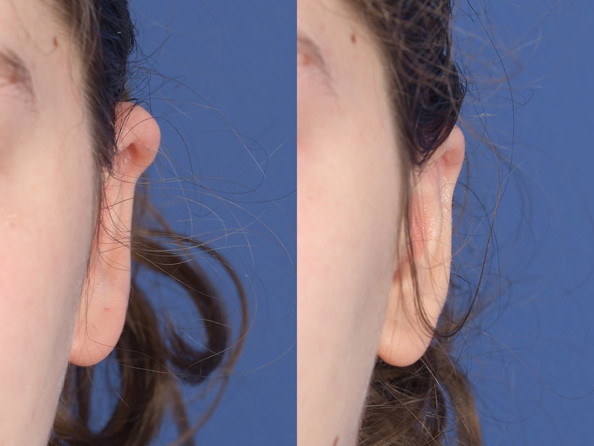 Otoplasty Before & After Gallery - Patient 330757 - Image 2