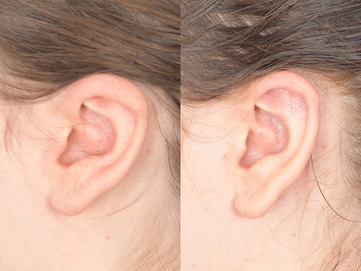 Otoplasty Before & After Gallery - Patient 330757 - Image 3