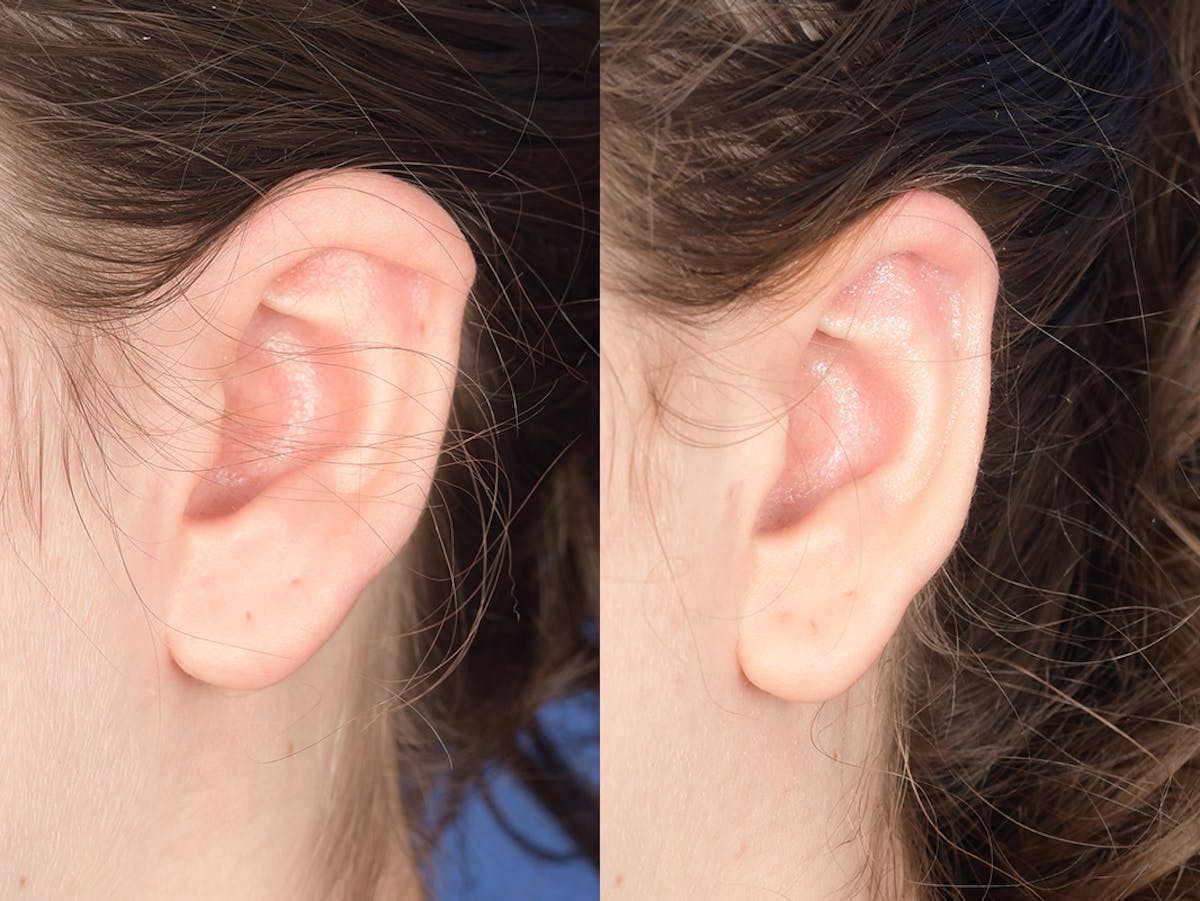 Otoplasty Before & After Gallery - Patient 330757 - Image 4