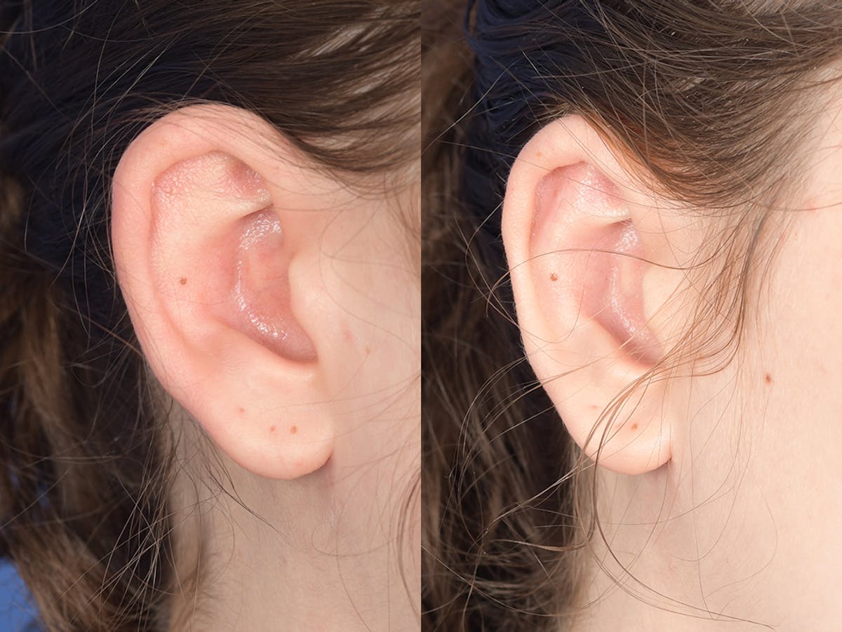 Otoplasty Before & After Gallery - Patient 330757 - Image 5