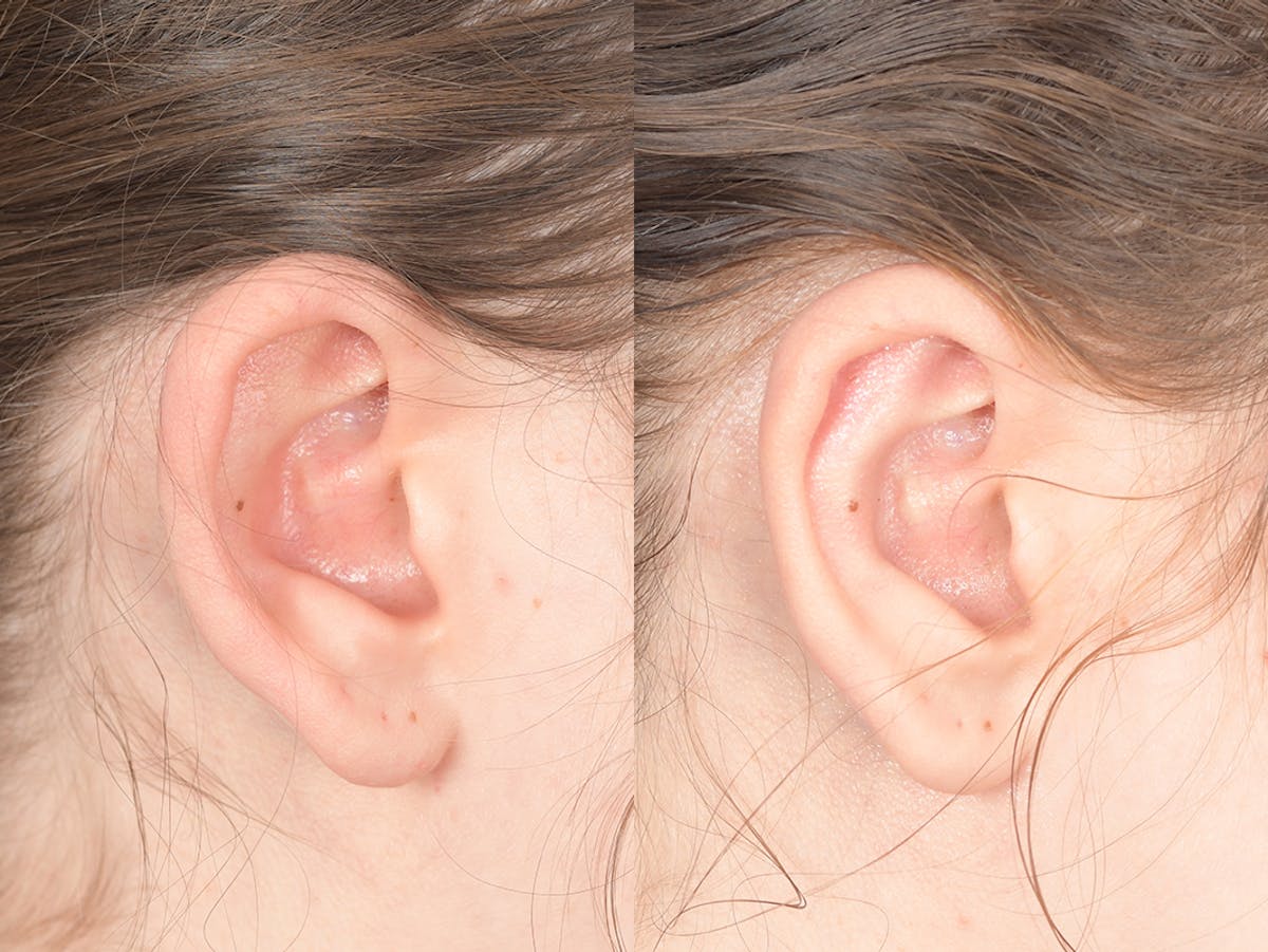 Otoplasty Before & After Gallery - Patient 330757 - Image 6