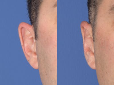 Otoplasty Before & After Gallery - Patient 381655 - Image 1