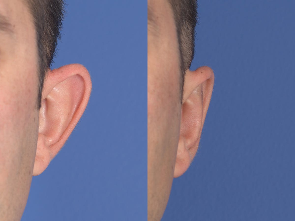 Otoplasty Before & After Gallery - Patient 381655 - Image 2